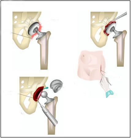 Revision Hip Replacement