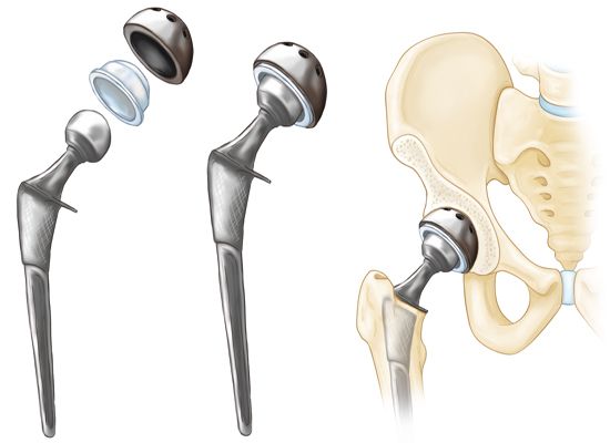 hip replacement surgeon in indore, Total Hip Replacement surgeon in India, Total Hip Replacement surgery in India