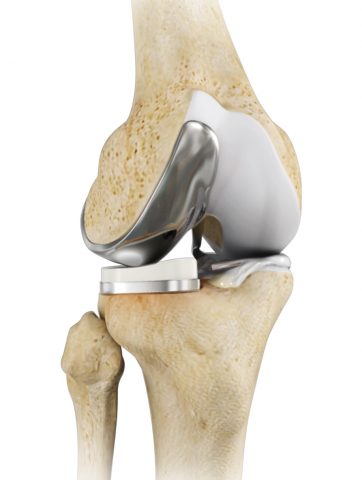 Best knee replacement surgeon in Indore