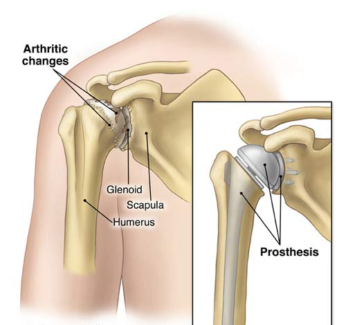 Total Shoulder Replacement