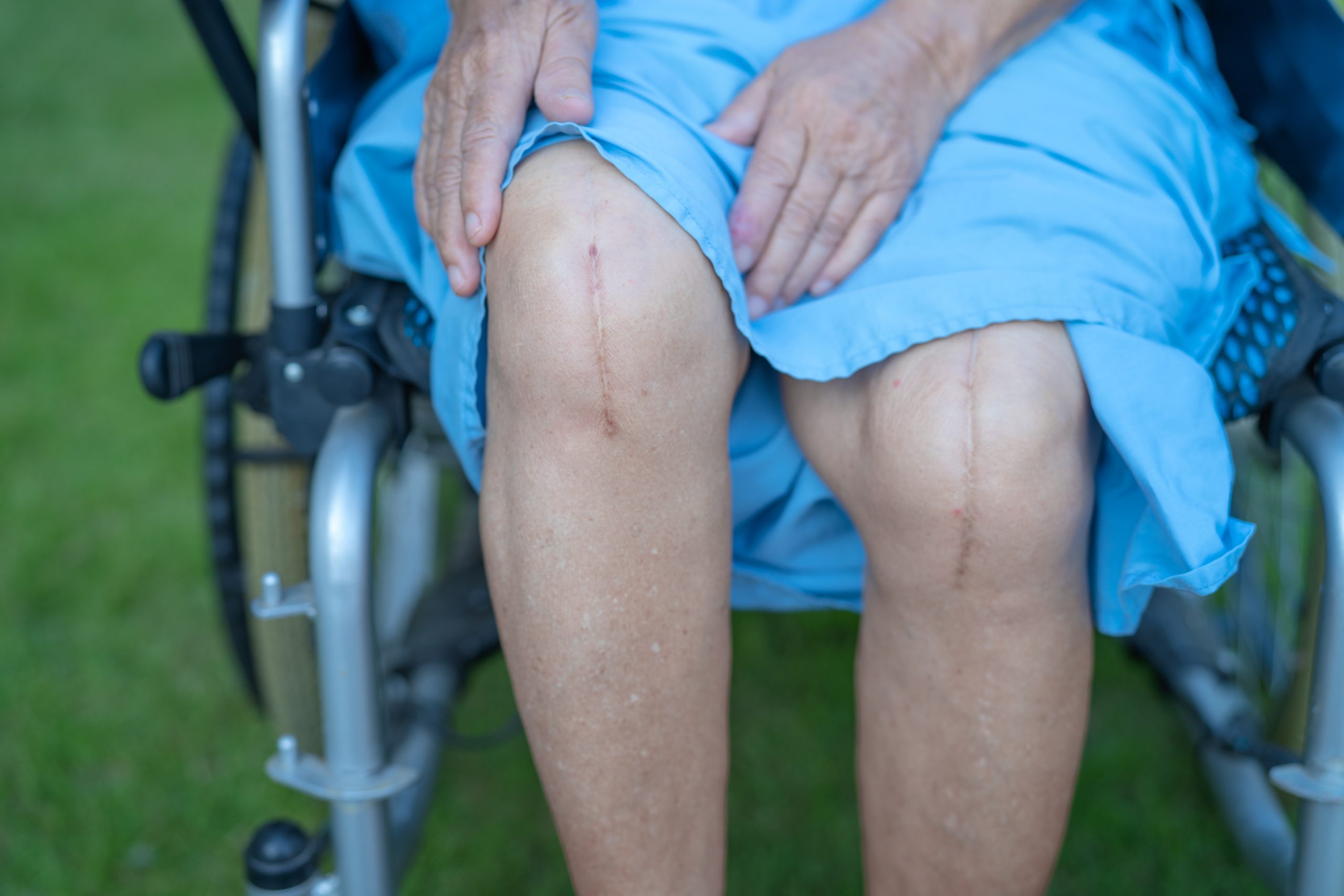 Same-Day Knee Replacement: Rapid Recovery Options For Joint Replacement 