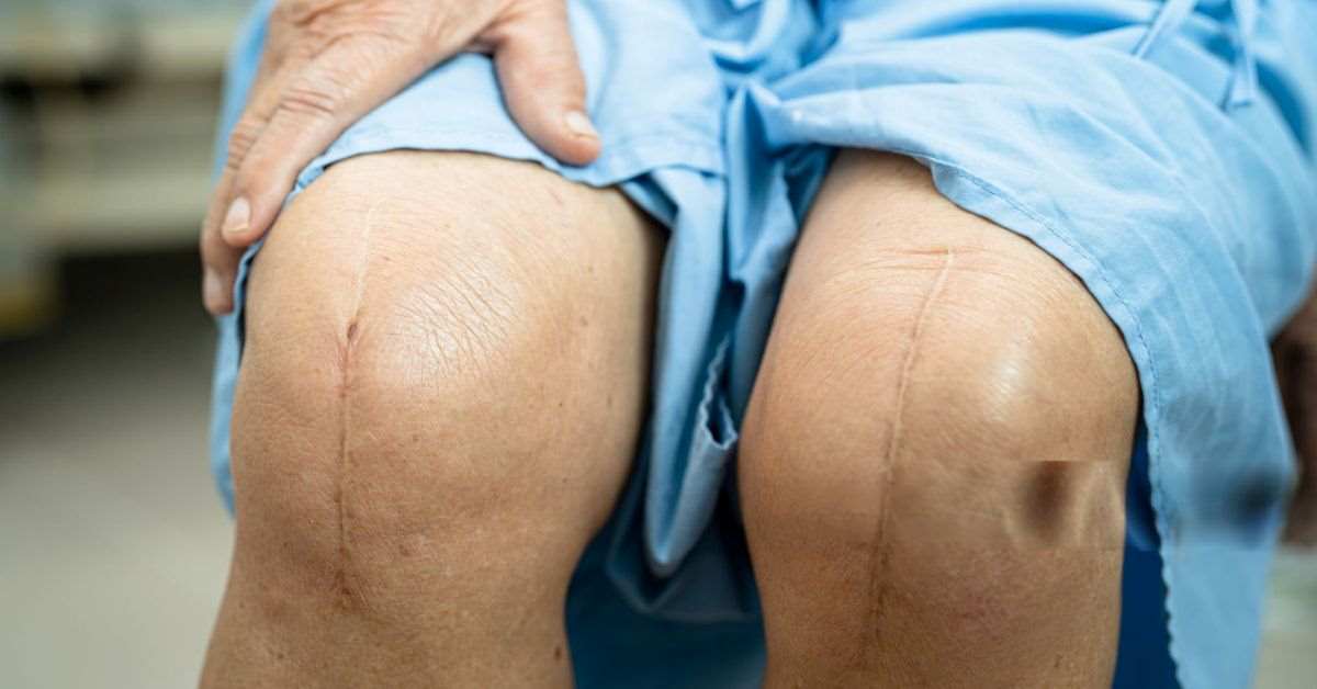 After Knee Replacement: Long-Term Benefits