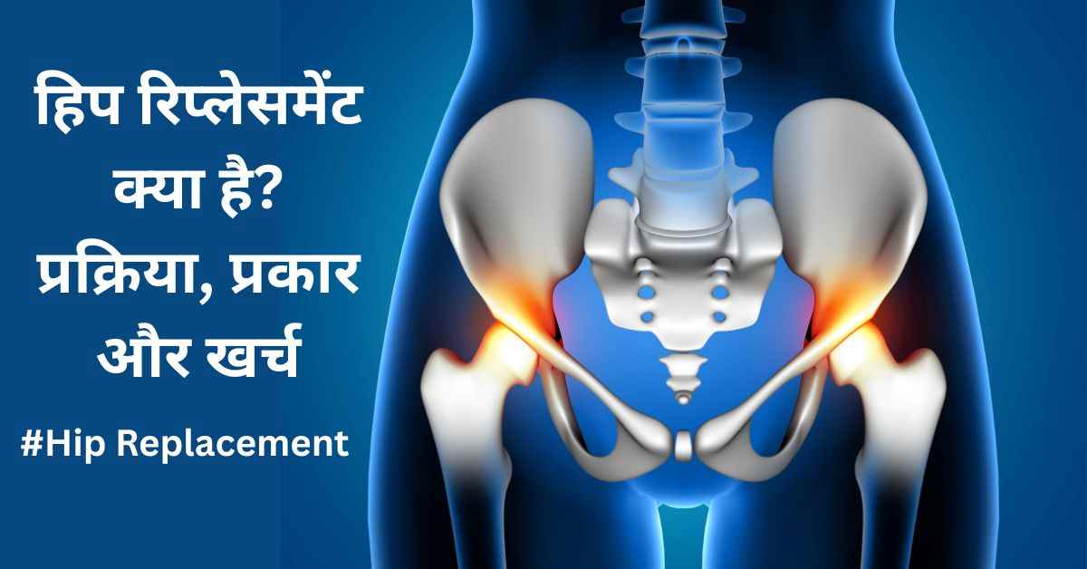 हिप रिप्लेसमेंट क्या है? प्रक्रिया, प्रकार और खर्च