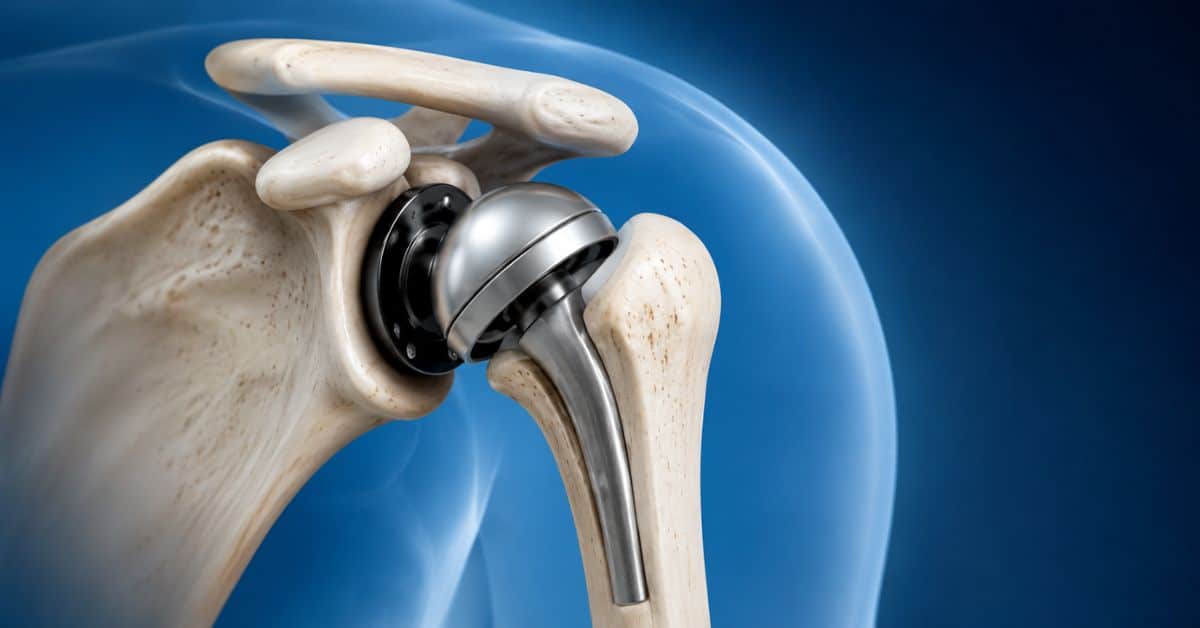 Shoulder Replacement Surgery – Procedure, Risks and Post Surgery Recovery